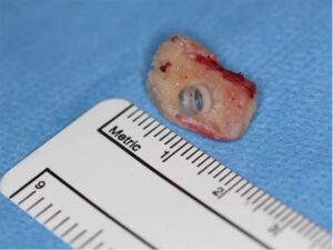 Remarkable “Tooth-In-Eye” Surgery Restores Eyesight To Blind
